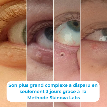 Skinova Labs™ - Dites Adieu aux acrochordons