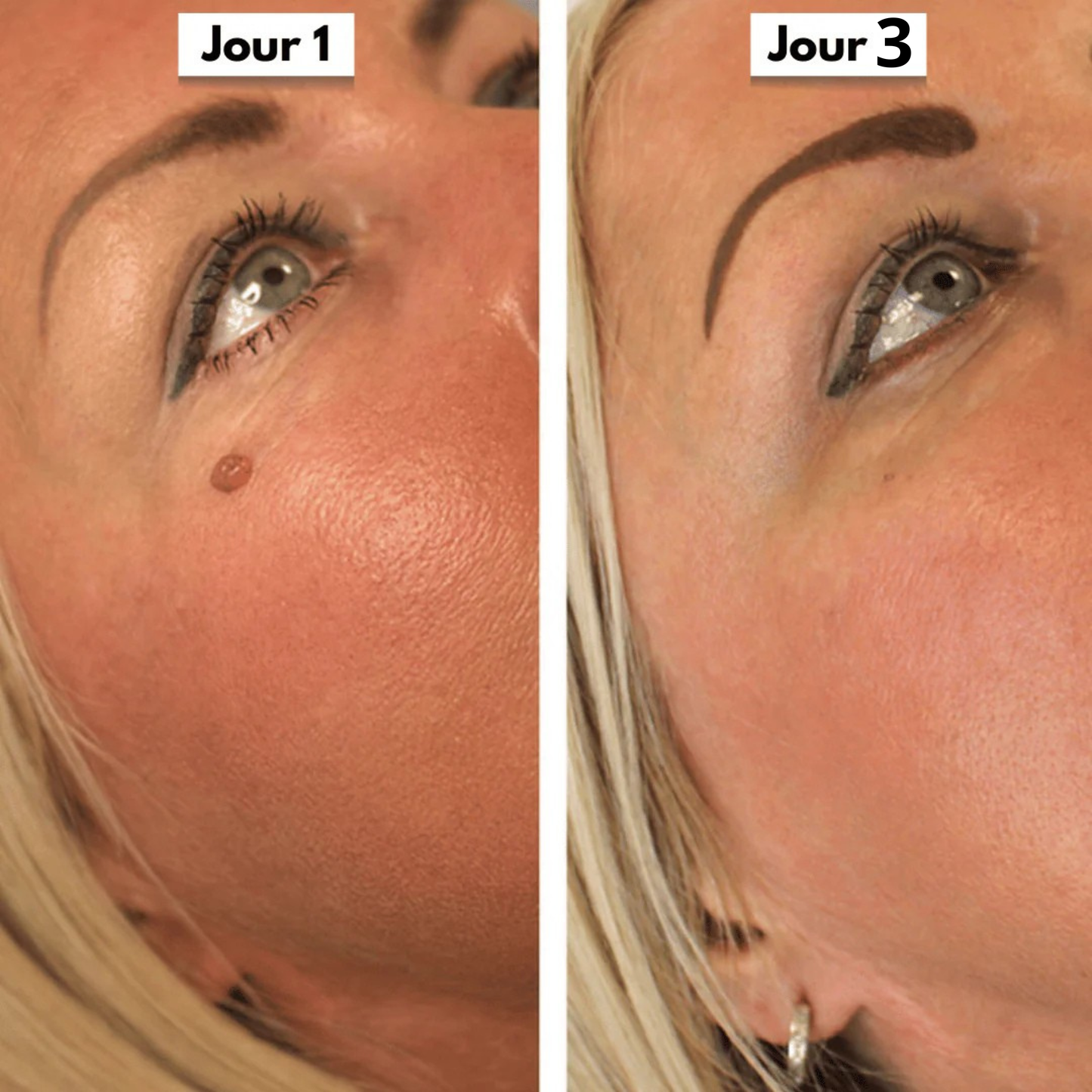 Skinova Labs™ - Dites Adieu aux acrochordons