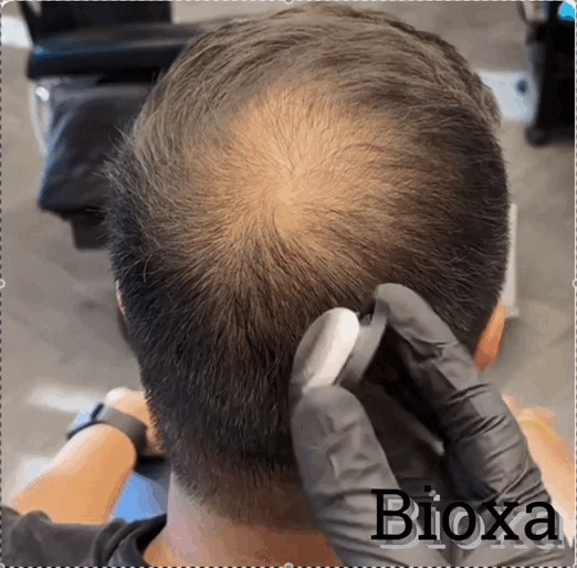 Camouflage Capillaire Bioxa